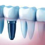 gums diseases enfermedad periodental encias periodontal